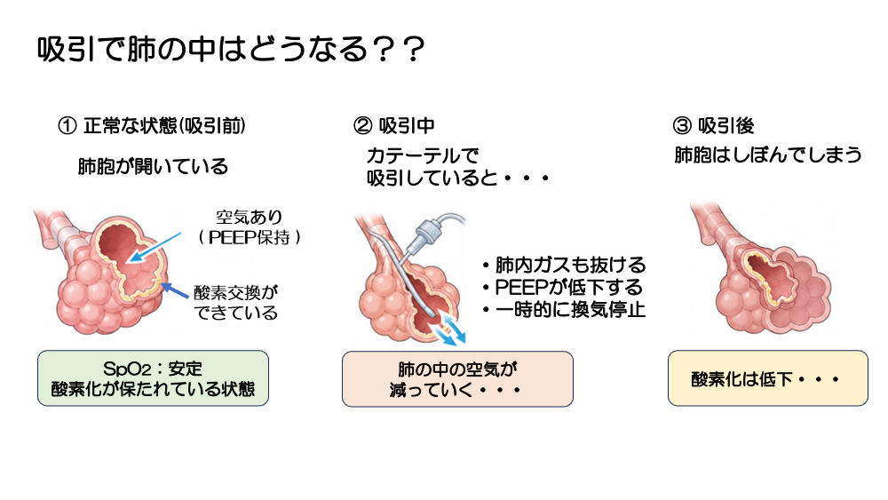 【全4回】その吸引、本当に必要ですか？